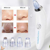 Electric Blackhead Remover & Pore Vacuum